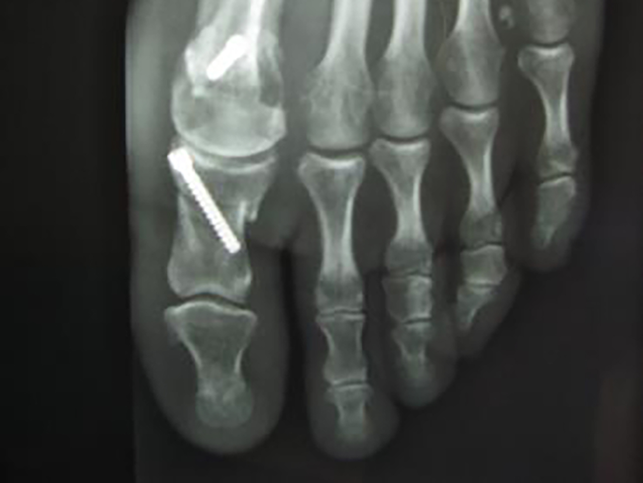Massues-radiologie-osteotomie-pied